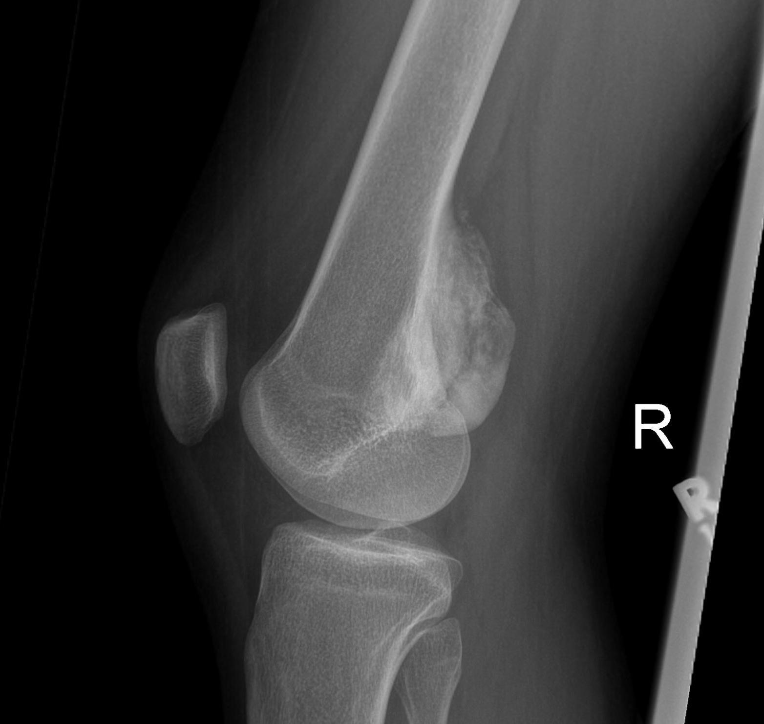 Parosteal Osteosarcoma Xray Lateral